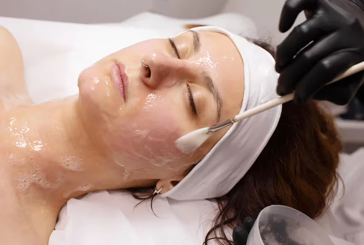 Chemical Peels