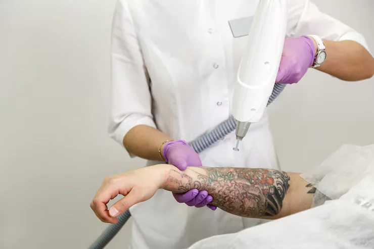 Tattoo Removal