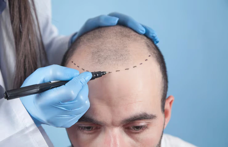 U-Graft Hair Transplantation